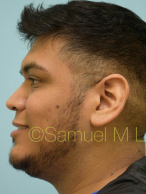 Rhinoplasty-Nose Job