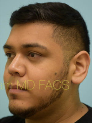 Rhinoplasty-Nose Job