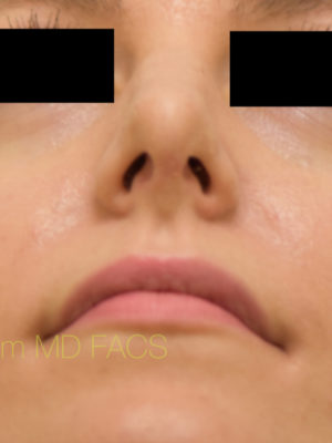 Rhinoplasty-Nose Job