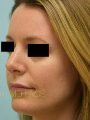 Rhinoplasty-Nose Job