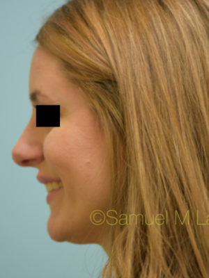 Rhinoplasty-Nose Job