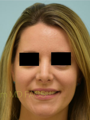 Rhinoplasty-Nose Job