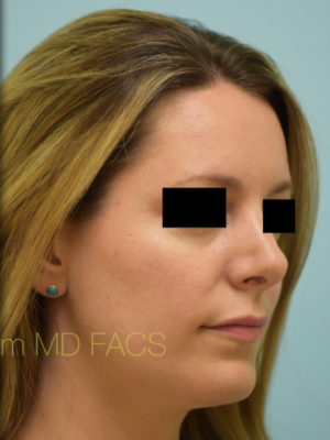 Rhinoplasty-Nose Job