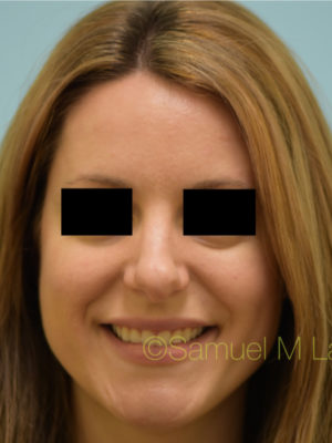 Rhinoplasty-Nose Job