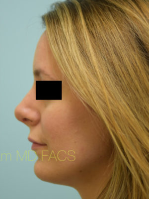 Rhinoplasty-Nose Job