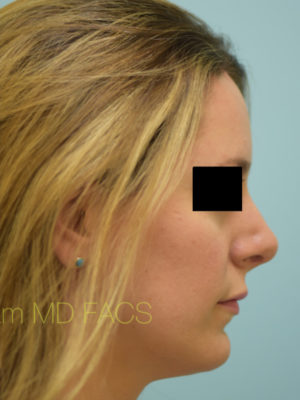 Rhinoplasty-Nose Job