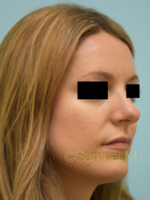 Rhinoplasty-Nose Job