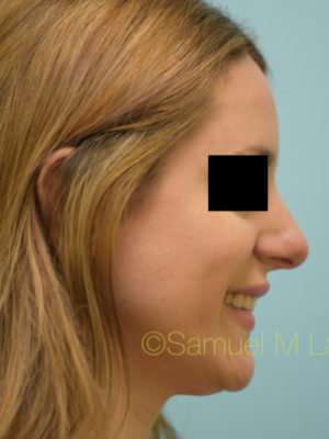 Rhinoplasty-Nose Job