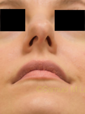 Rhinoplasty-Nose Job