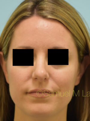 Rhinoplasty-Nose Job