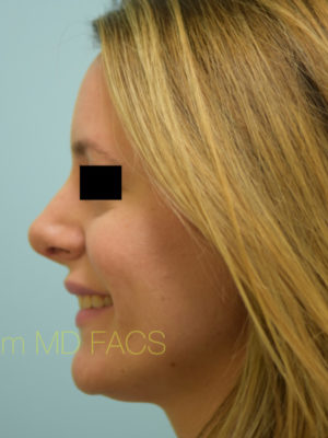 Rhinoplasty-Nose Job