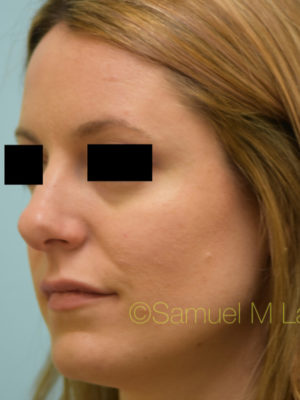Rhinoplasty-Nose Job