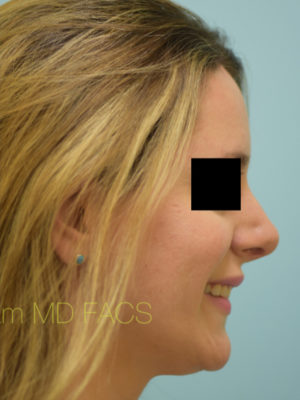 Rhinoplasty-Nose Job