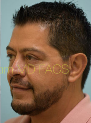 Lower Face & Neck Rejuvenation
