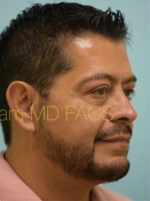 Lower Face & Neck Rejuvenation