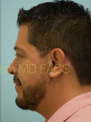 Lower Face & Neck Rejuvenation