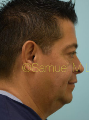 Chin Augmentation
