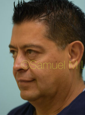 Chin Augmentation