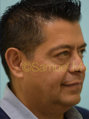 Chin Augmentation