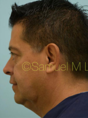Chin Augmentation