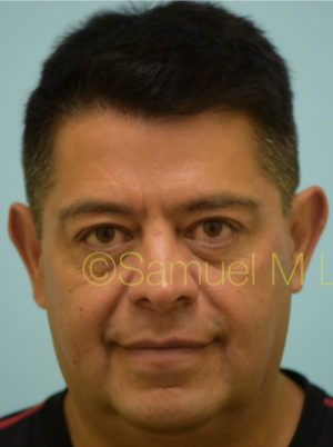 Chin Augmentation
