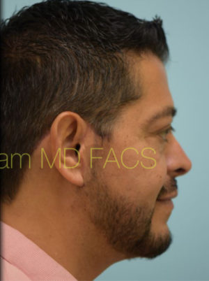 Chin Augmentation