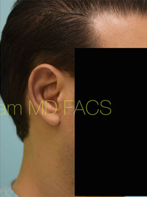 Otoplasty (Cosmetic Ear Reshaping)