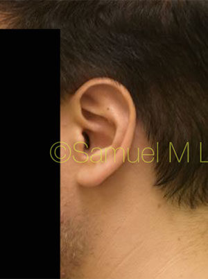 Otoplasty (Cosmetic Ear Reshaping)