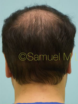 Otoplasty (Cosmetic Ear Reshaping)