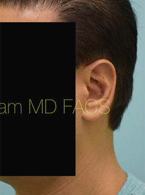 Otoplasty (Cosmetic Ear Reshaping)