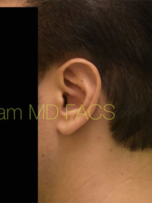 Otoplasty (Cosmetic Ear Reshaping)