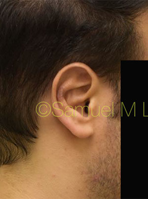 Otoplasty (Cosmetic Ear Reshaping)