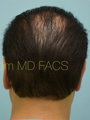 Otoplasty (Cosmetic Ear Reshaping)