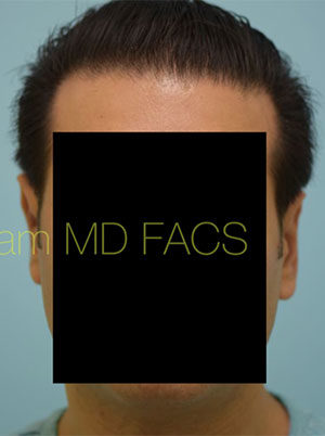 Otoplasty (Cosmetic Ear Reshaping)