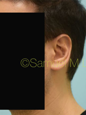 Otoplasty (Cosmetic Ear Reshaping)