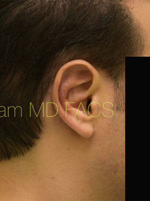 Otoplasty (Cosmetic Ear Reshaping)