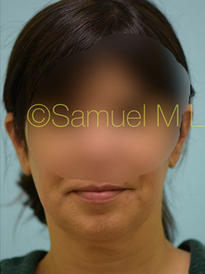 Chin Augmentation