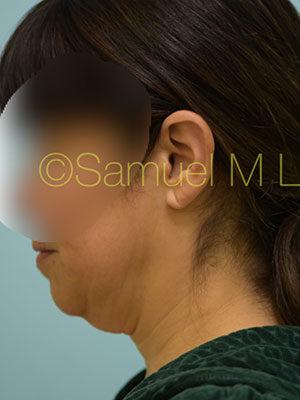 Chin Augmentation