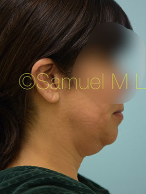 Chin Augmentation