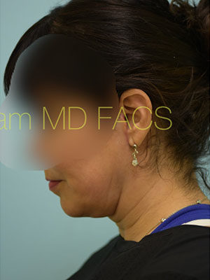 Chin Augmentation