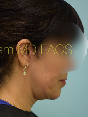 Chin Augmentation