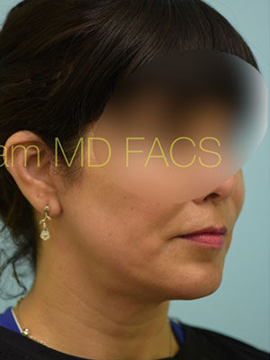 Chin Augmentation