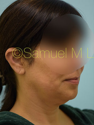 Chin Augmentation
