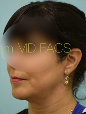 Chin Augmentation