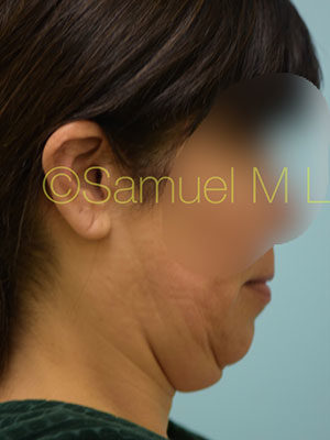 Chin Augmentation