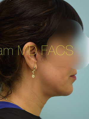 Chin Augmentation