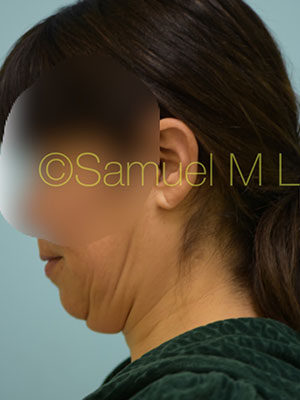 Chin Augmentation
