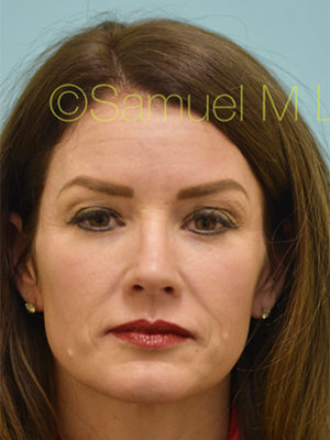 Botox