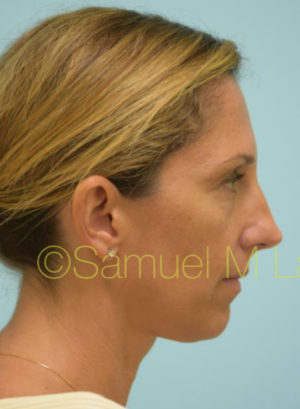 Eyelid Rejuvenation