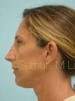 Eyelid Rejuvenation